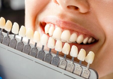 کامپوزیت دندان