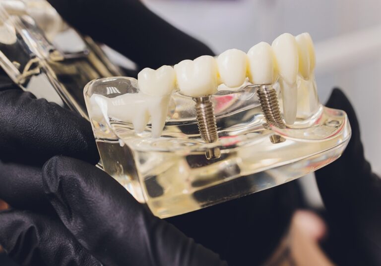 ایمپلنت دندان