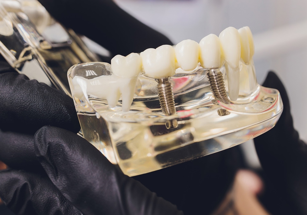 ایمپلنت دندان