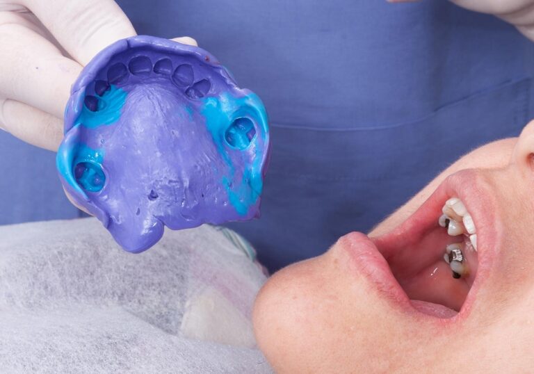 قالب گیری روکش دندان