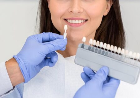 لمینت دندان