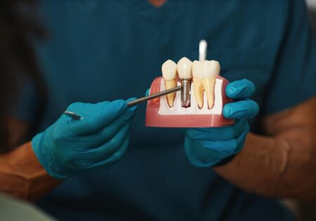 پوشش نقره: نقش کلیدی در کاهش عفونت های دندانی